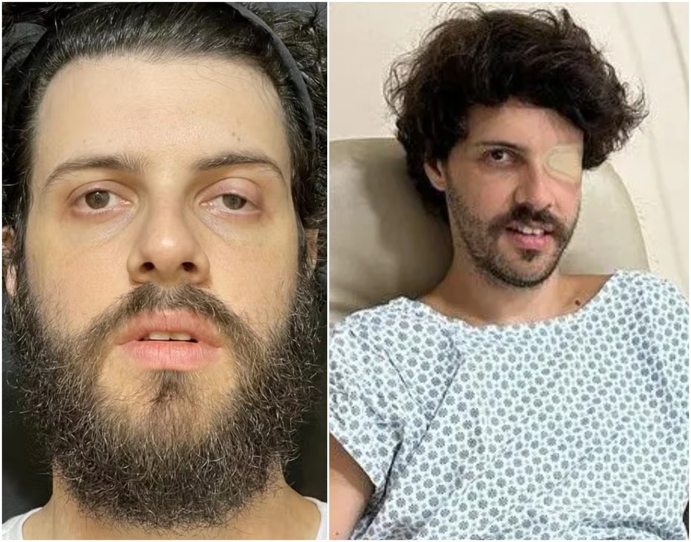Diogo Defante retirou tumor em 2024 — Foto: Reprodução/Instagram