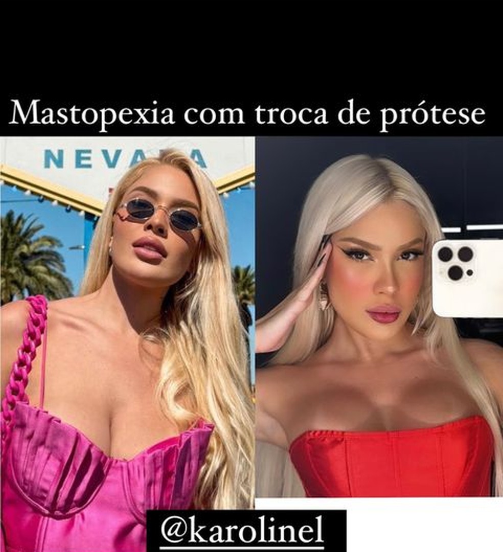 Karoline Lima antes e depois de plsticas nos seios  Foto: Reproduo/Instagram