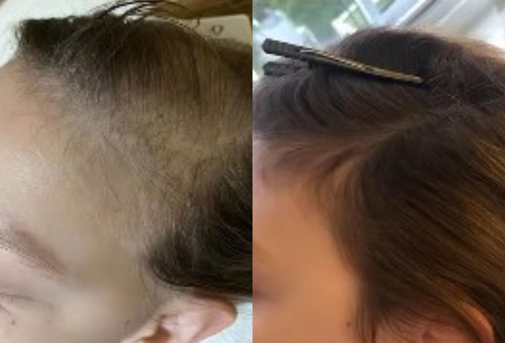 Bruna Furlan se emociona com crescimento do cabelo após câncer — Foto: Reprodução/Instagram