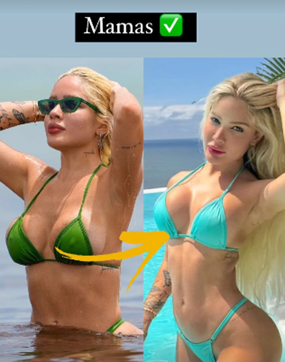 Karoline Lima antes e depois de plsticas nos seios  Foto: Reproduo/Instagram