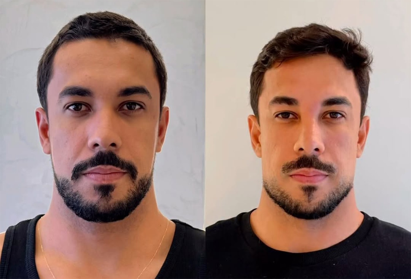 Ex-BBB Maike comenta repercussão de harmonização facial: 'Tava ruim, já' - Foto