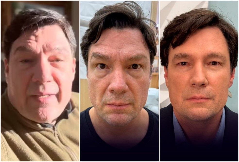 Mudança de Ricardo Macchi antes e após a harmonização feita em 2025 — Foto: Reprodução/Instagram
