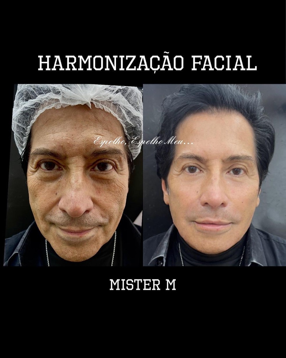 Val Valentino, o Mister M, faz harmonização facial — Foto: Reprodução/Instagram
