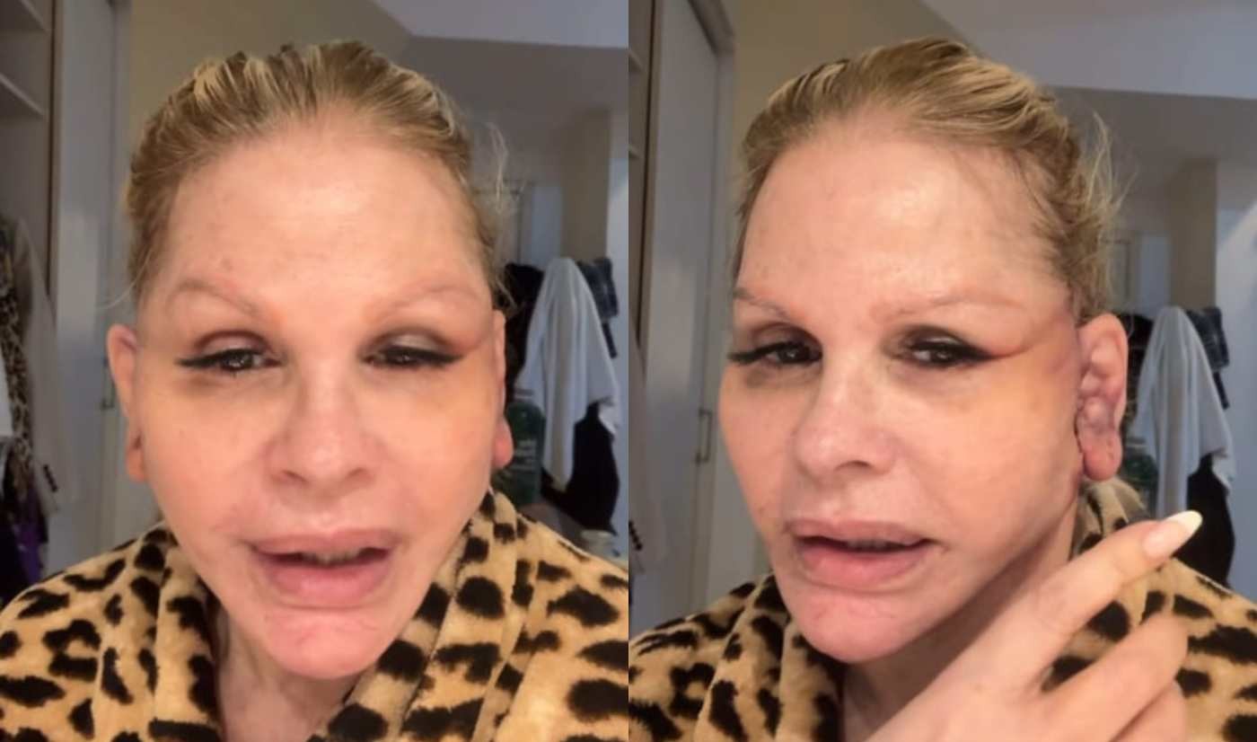 Monique Evans mostra recuperação após cirurgia facial e relata problema com banco: 