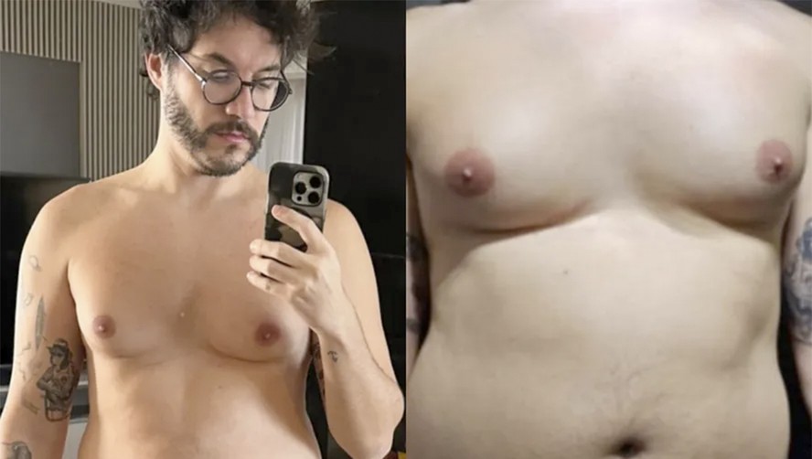 Eliezer é submetido a cirurgia de ginecomastia com lipoaspiração