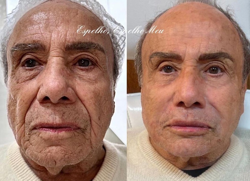 O antes e depois de Stênio Garcia — Foto: Reprodução Instagram