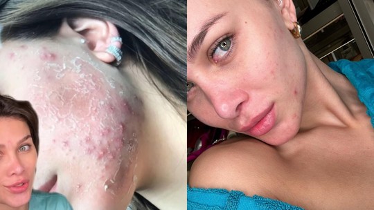 Flavia Pavanelli mostra trajetória de problemas com acne