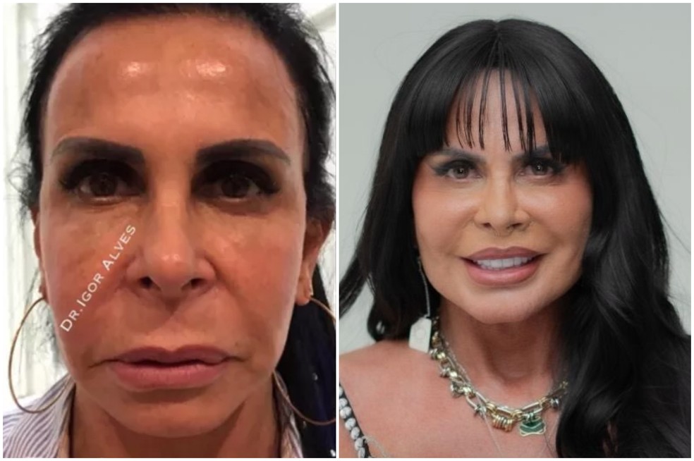Antes e depois de Gretchen  — Foto: Reprodução/Instagram