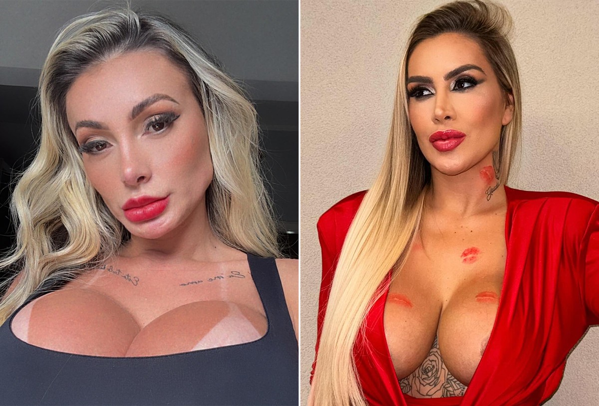 Andressa Urach tira pontos de rosto após briga com Juju Ferrari; vídeo