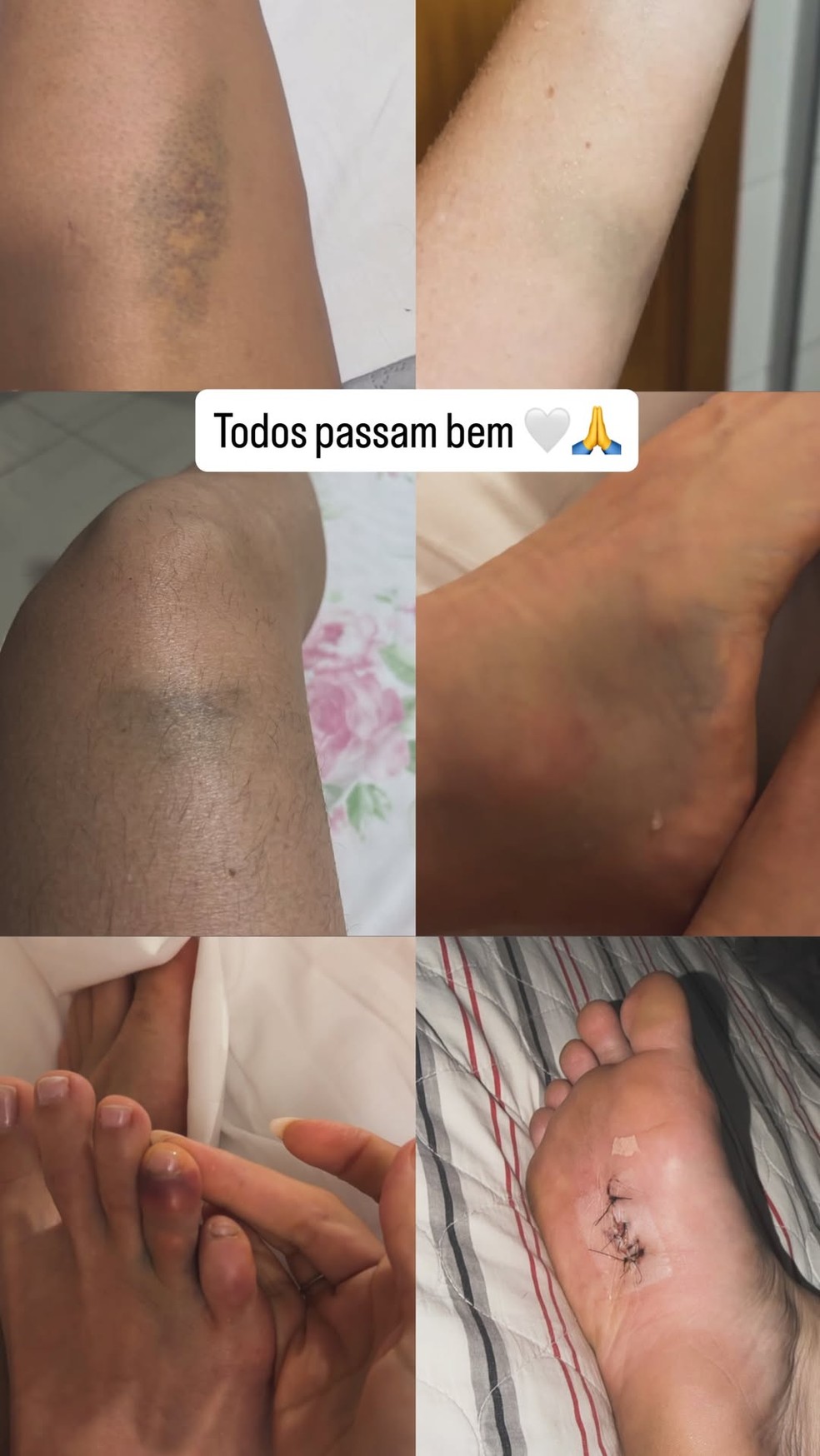 Juliette e amigos ficaram com machucados após despedida de solteira — Foto: Reprodução/Instagram