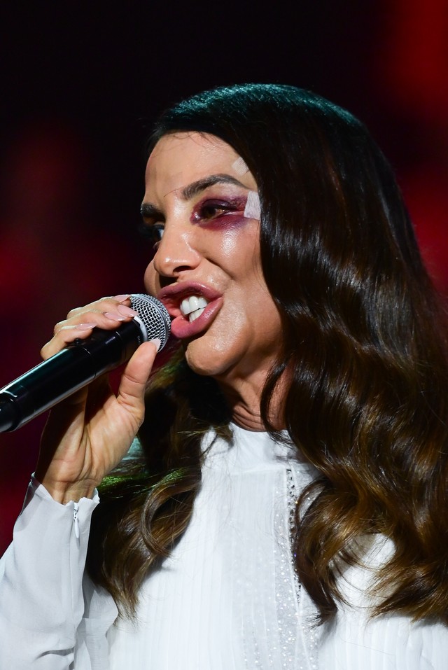 Com hematoma no rosto, Ivete faz primeiro show após desmaiar e cair em ...
