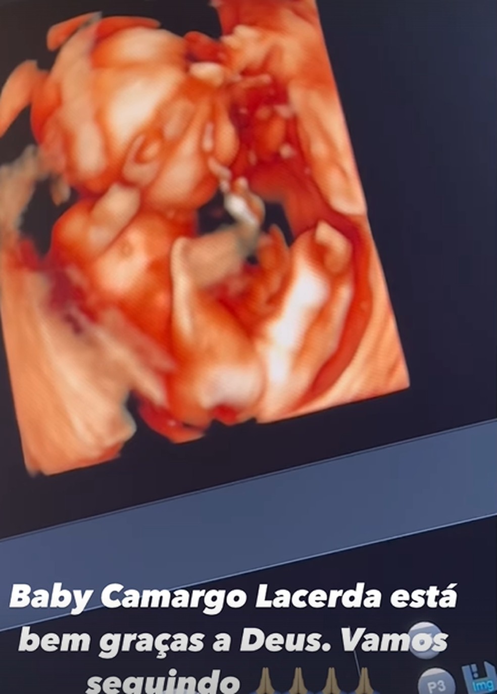 Ultrassom do filho de Graciele Lacerda e Zezé di Camargo — Foto: Reprodução/Instagram