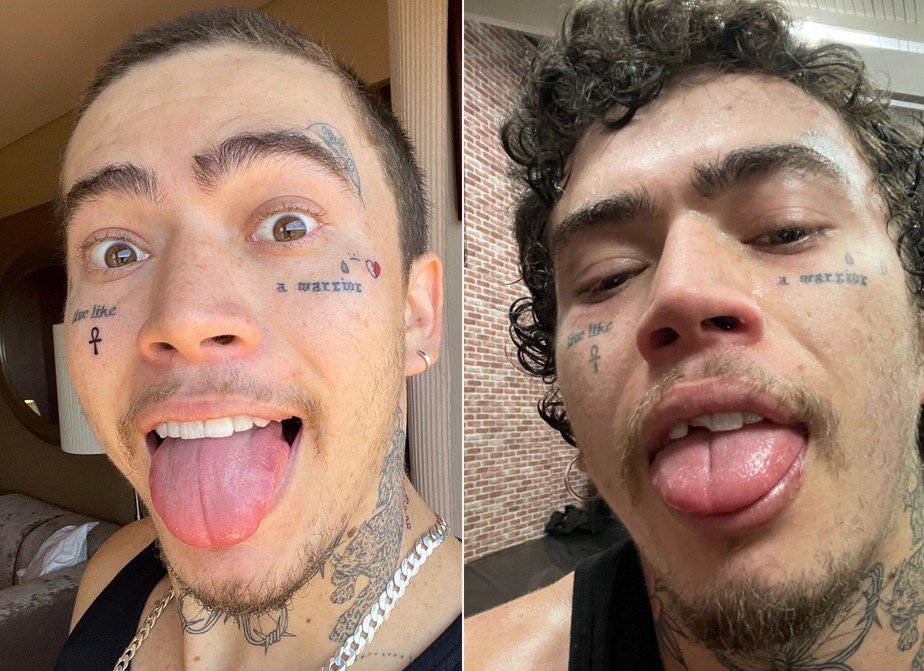 O que o Whindersson fez nos dentes?