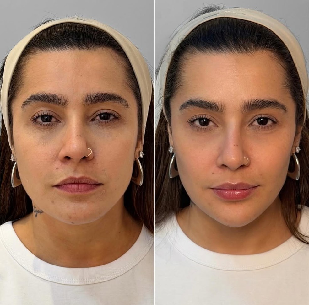 Antes e depois: Lauana Prado passa por harmonização facial — Foto: Reprodução/Instagram