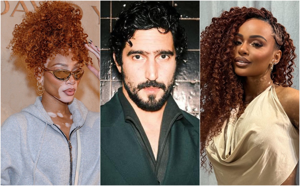 Vitiligo: Além de Renato Góes, Conheça Outras Celebridades que Vivem com a Condição e Inspiram a Autoestima