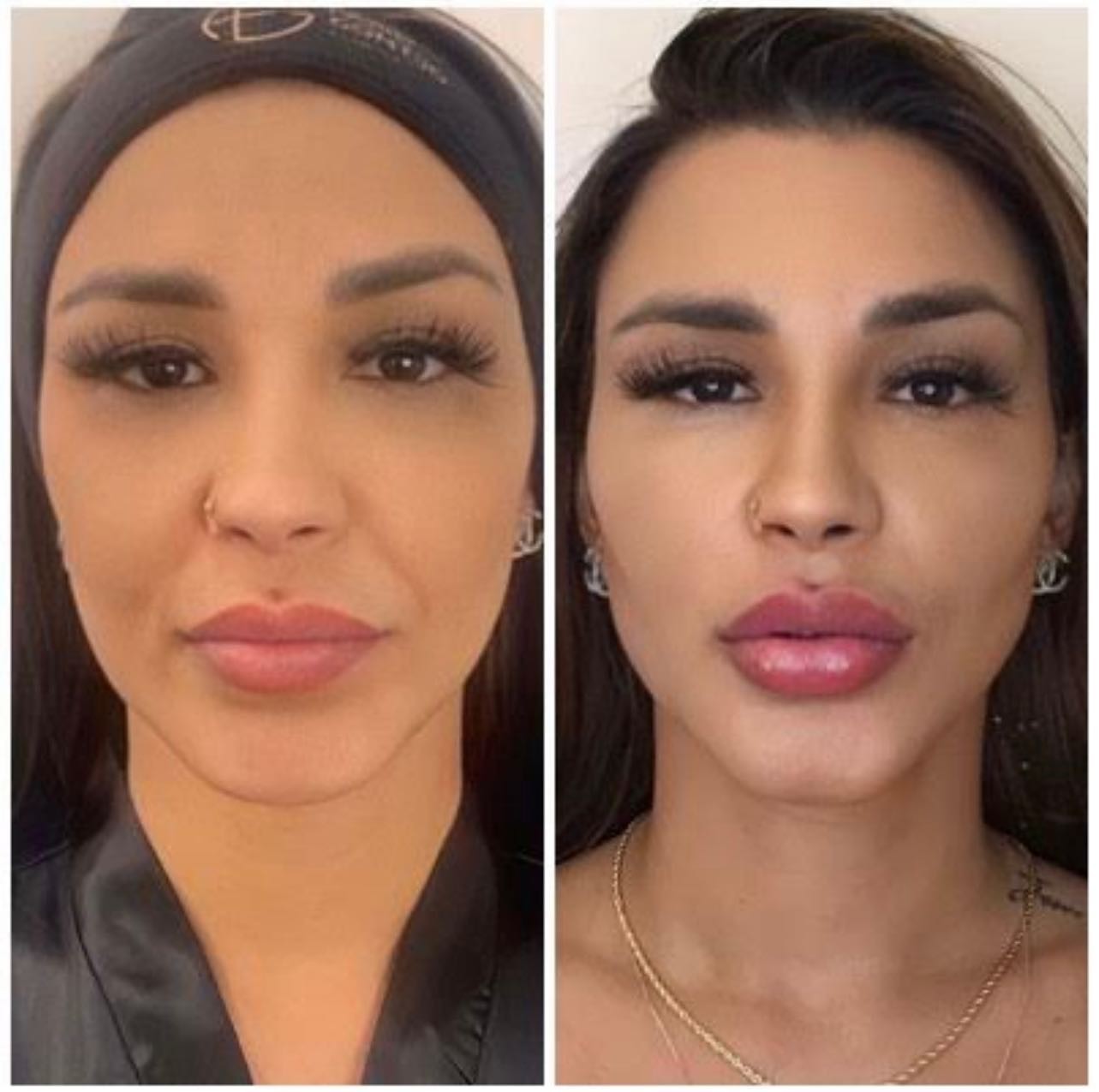 Jenny Miranda mostra resultado de harmonização facial no Instagram — Foto: Reprodução / Instagram