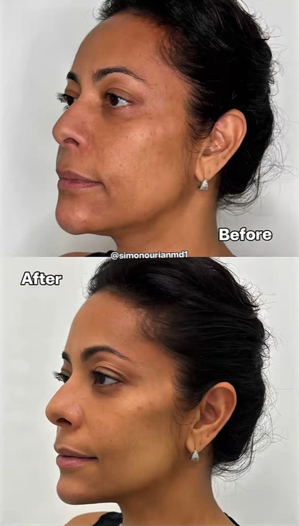 Samantha Schmütz Antes E Depois