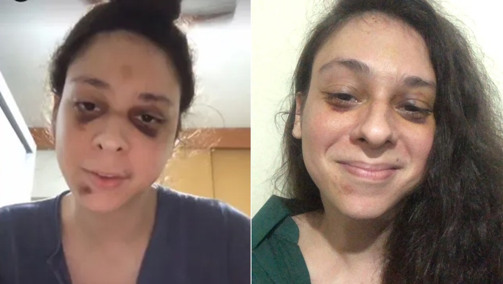 Antes e depois: após agressão, Victor Meyniel mostra hematomas menos evidentes — Foto: Instagram