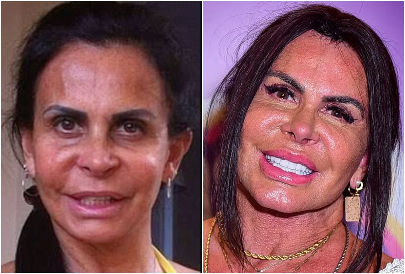 Gretchen mostra antes e depois de procedimentos: '5 anos fazendo'