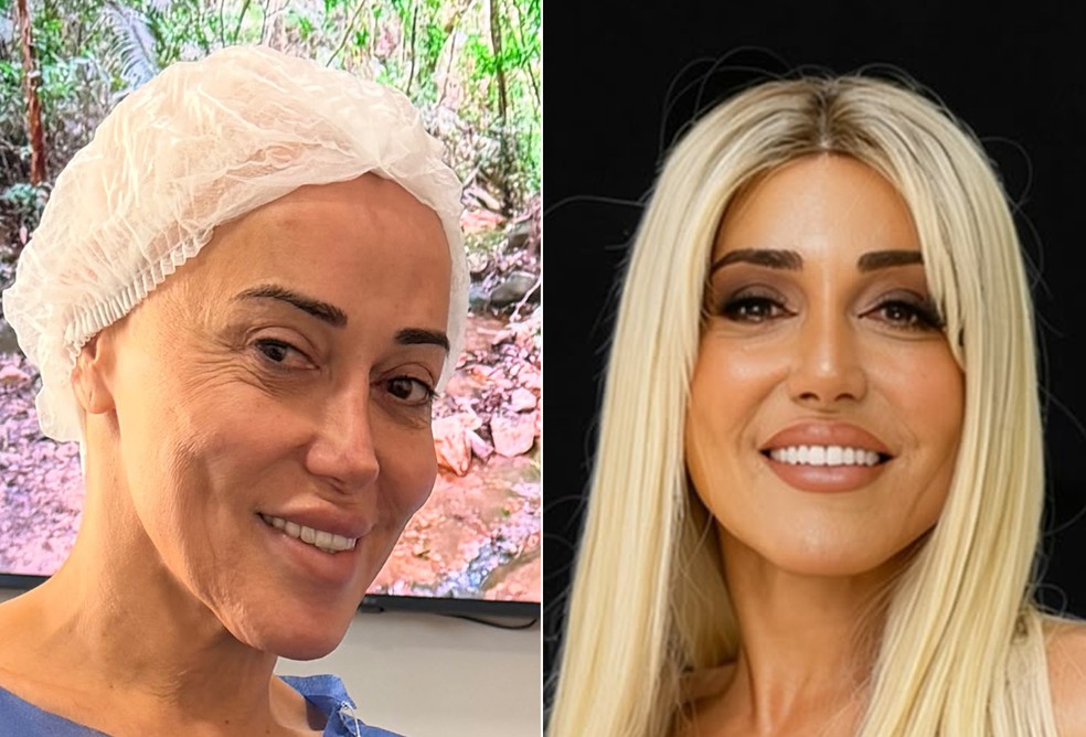 Marcela Porto, a Mulher Abacaxi, antes e depois da feminização facial — Foto: Arquivo pessoal
