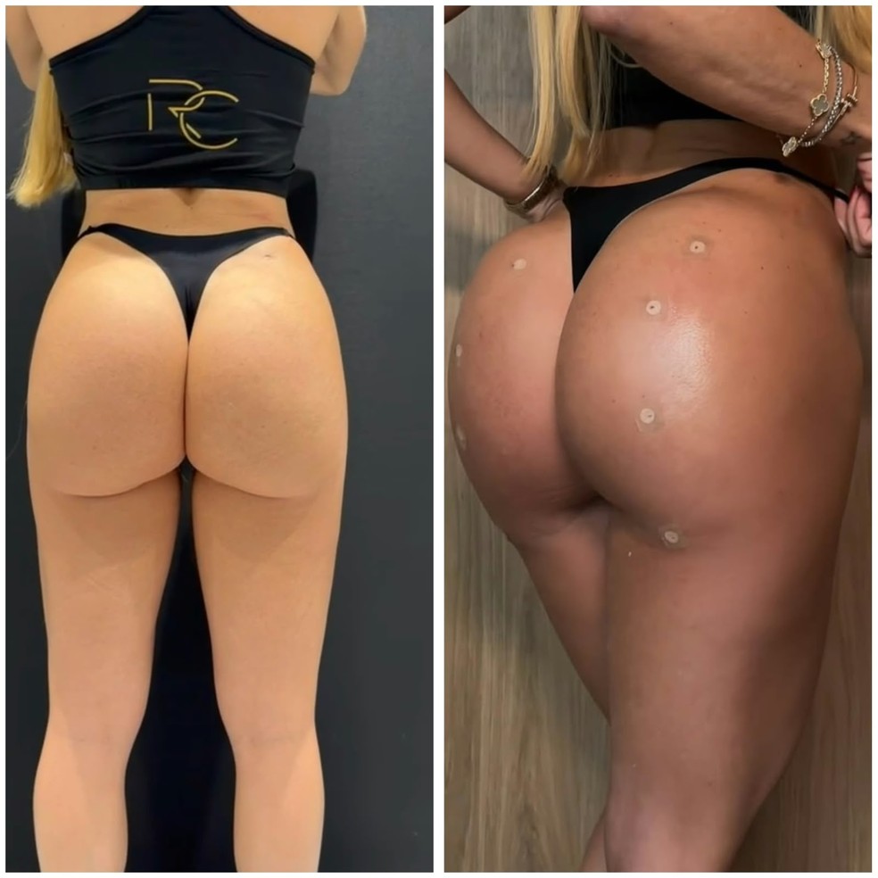 Denise Dias aplica ácido hialurônico no bumbum — Foto: Divulgação