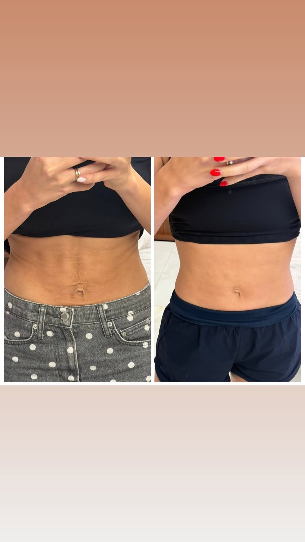 Um mês após reclamar de barriga 'flácida' e 'umbigo caído', Lyandra Costa se surpreende com resultado de procedimento — Foto: Reprodução/Instagram