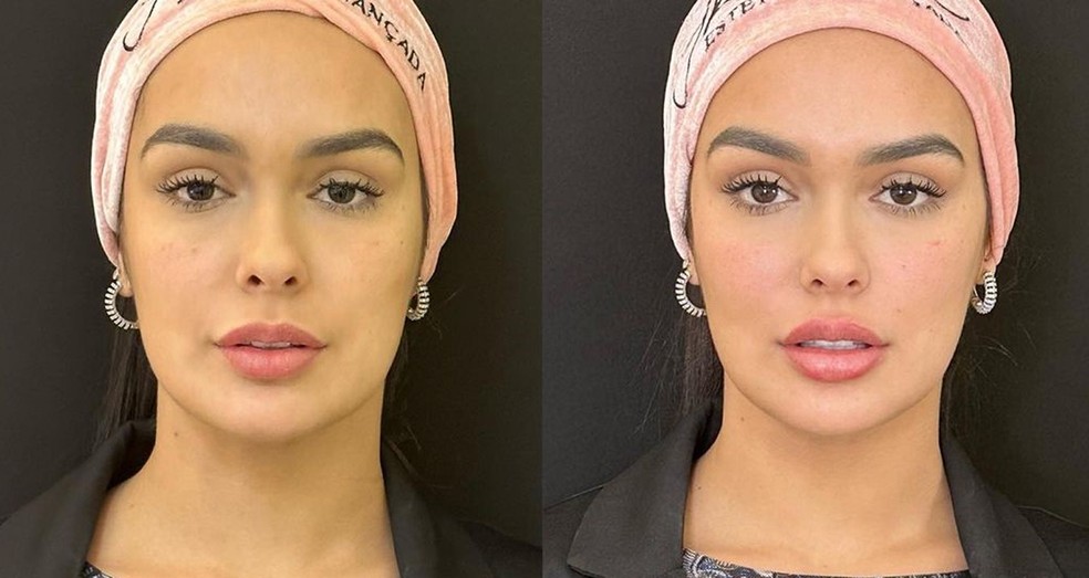 Ex-BBB Larissa Santos harmoniza o rosto — Foto: Reprodução Instagram