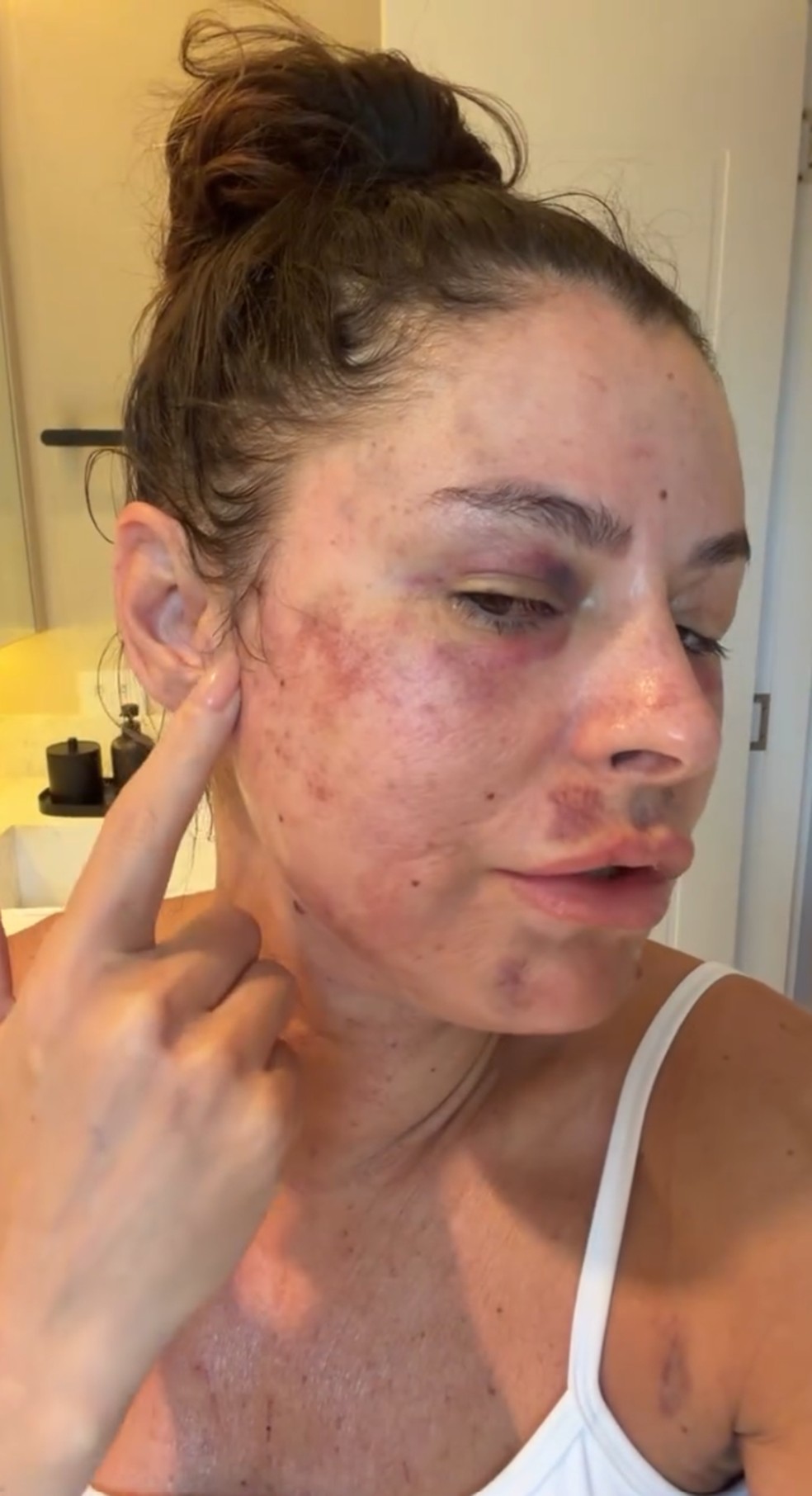 Ketryn Goetten fala sobre pós cirúrgico — Foto: Reprodução/Instagram