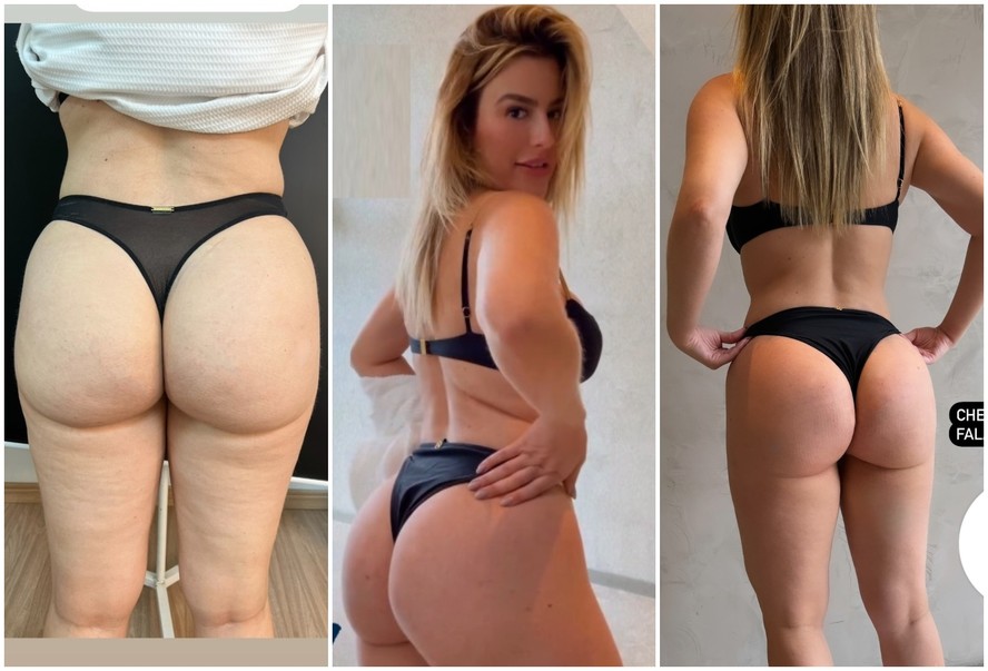 Fernanda Keulla mostra antes e depois de procedimento estético
