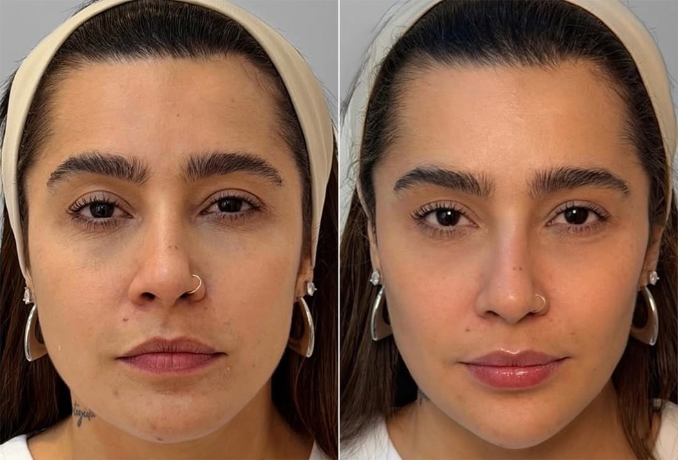 Antes e depois: Lauana Prado passa por harmonização facial — Foto: Reprodução/Instagram