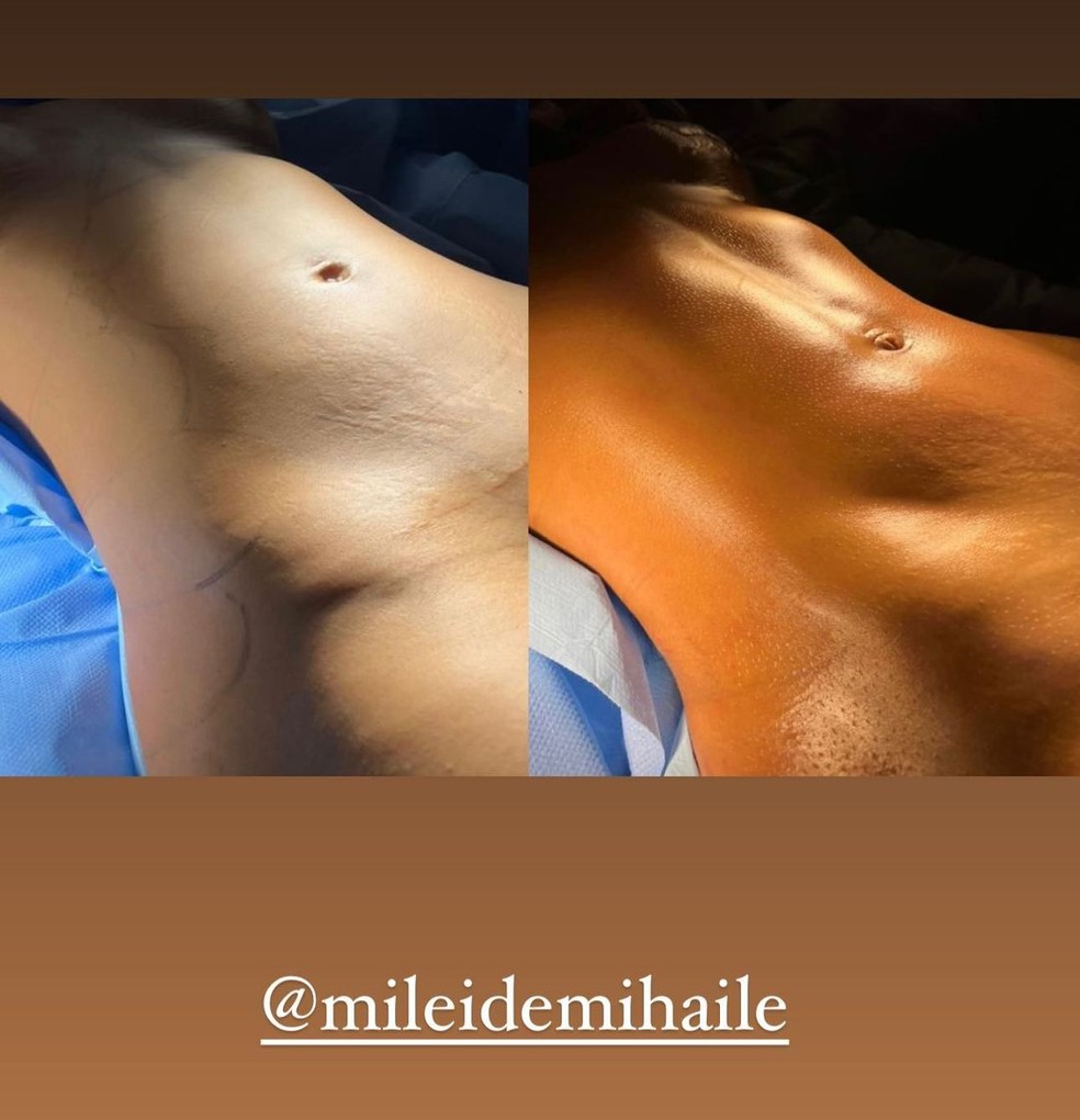 Mileide Mihaile abre o jogo sobre cirurgias plásticas e desabafa