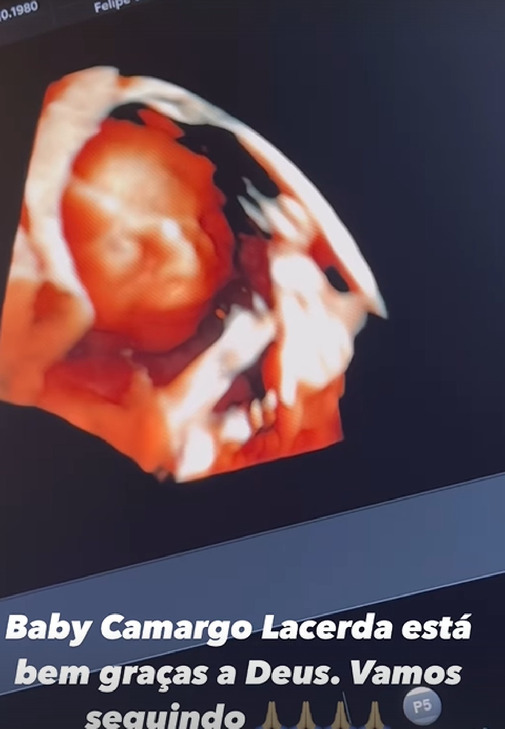 Ultrassom do filho de Graciele Lacerda e Zezé di Camargo — Foto: Reprodução/Instagram