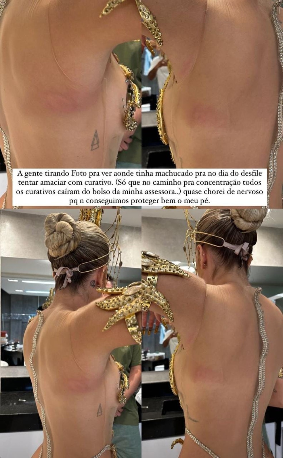 Lore Improta mostra machucados após desfile — Foto: Reprodução/Instagram