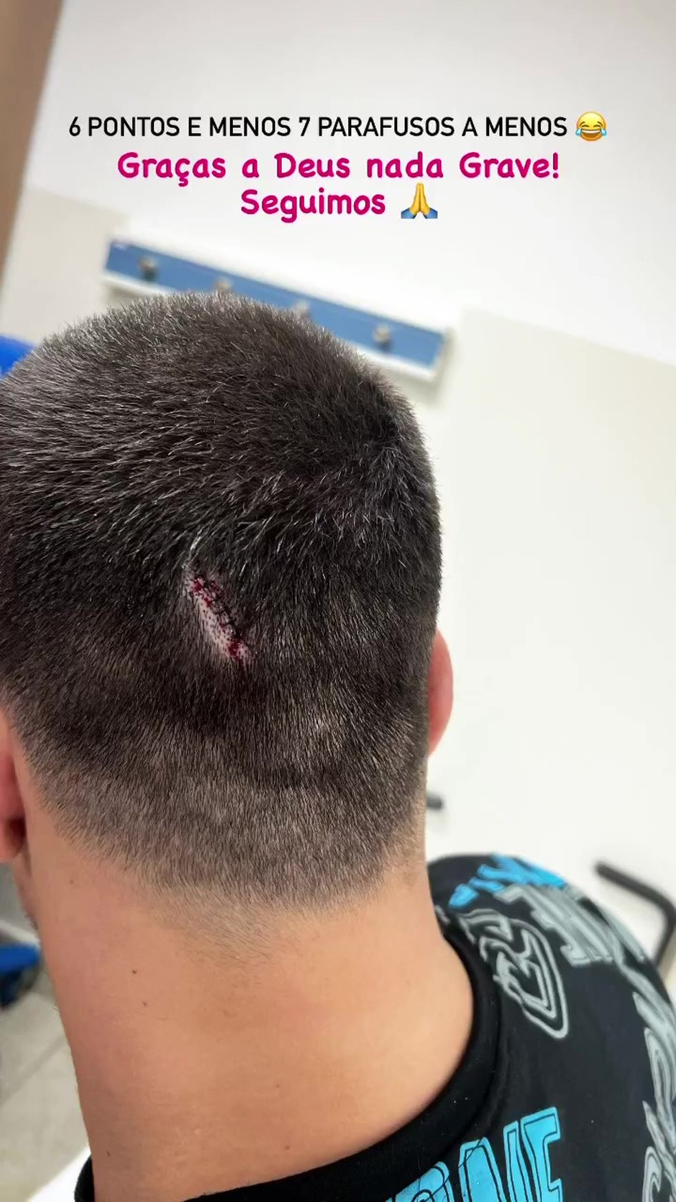 Thiago Martins mostra ferimento na cabeça — Foto: Instagram