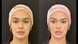 Antes e depois da harmonização de Larissa Santos — Foto: Reprodução Instagram