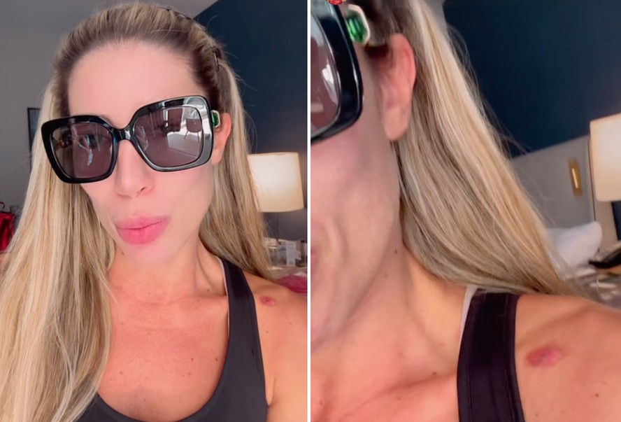 Tati Minerato mostra machucado após desfile: 'Tá na carne viva'