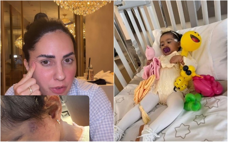 Graciele Lacerda mostra Clara após cirurgia para retirada de nódulo no rosto