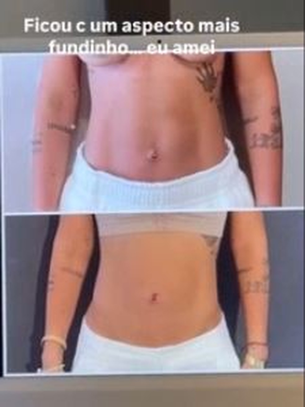 Virginia Fonseca exibe antes e depois de cirurgia para hérnia umbilical e retirada de excesso de pele — Foto: Reprodução/Instagram