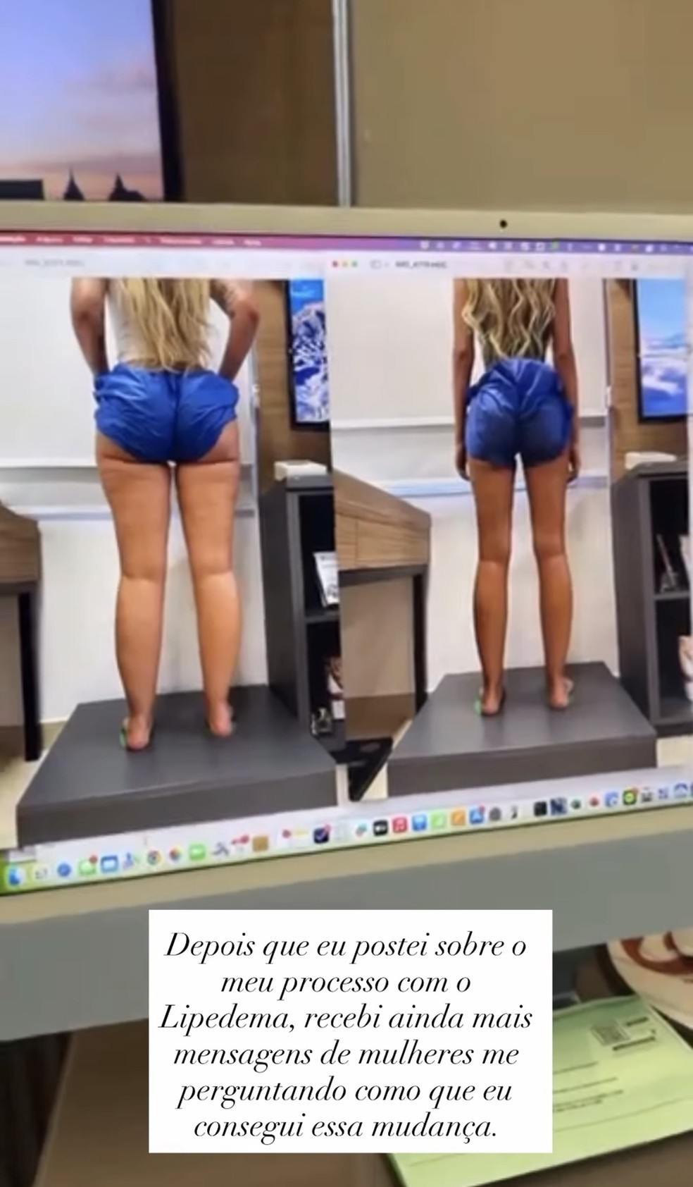 Yasmin Brunet fala sobre perda de peso após tratamento de lipedema e ...