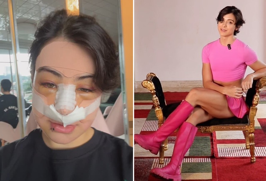 Sem curativos, Zé Longuinho mostra resultado de feminização facial; compare