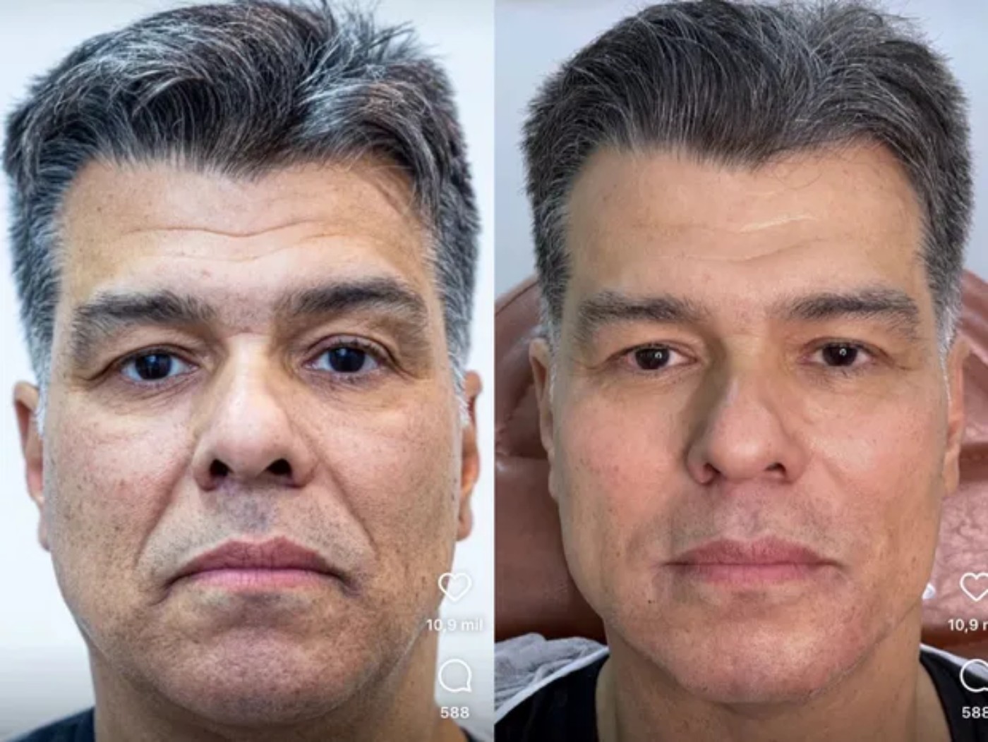 Antes e depois de harmonização facial de Maurício Mattar — Foto: Reprodução/Instagram