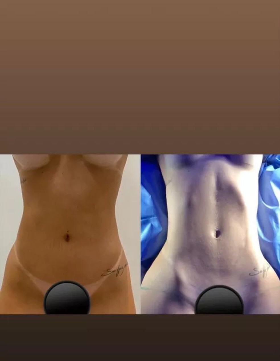 Antes e depois da lipo LAD de Virginia Fonseca, em 2020 — Foto: Reprodução / Instagram