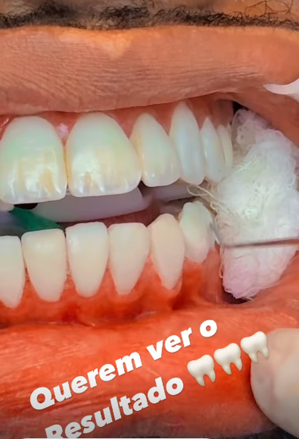 Davi Brito mostra dentes — Foto: Reprodução/Instagram