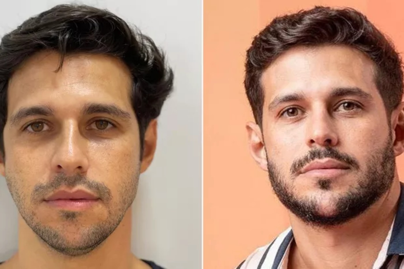 Rodrigo Mussi antes e depois da harmonização facial — Foto: Divulgação e Globo/João Cotta