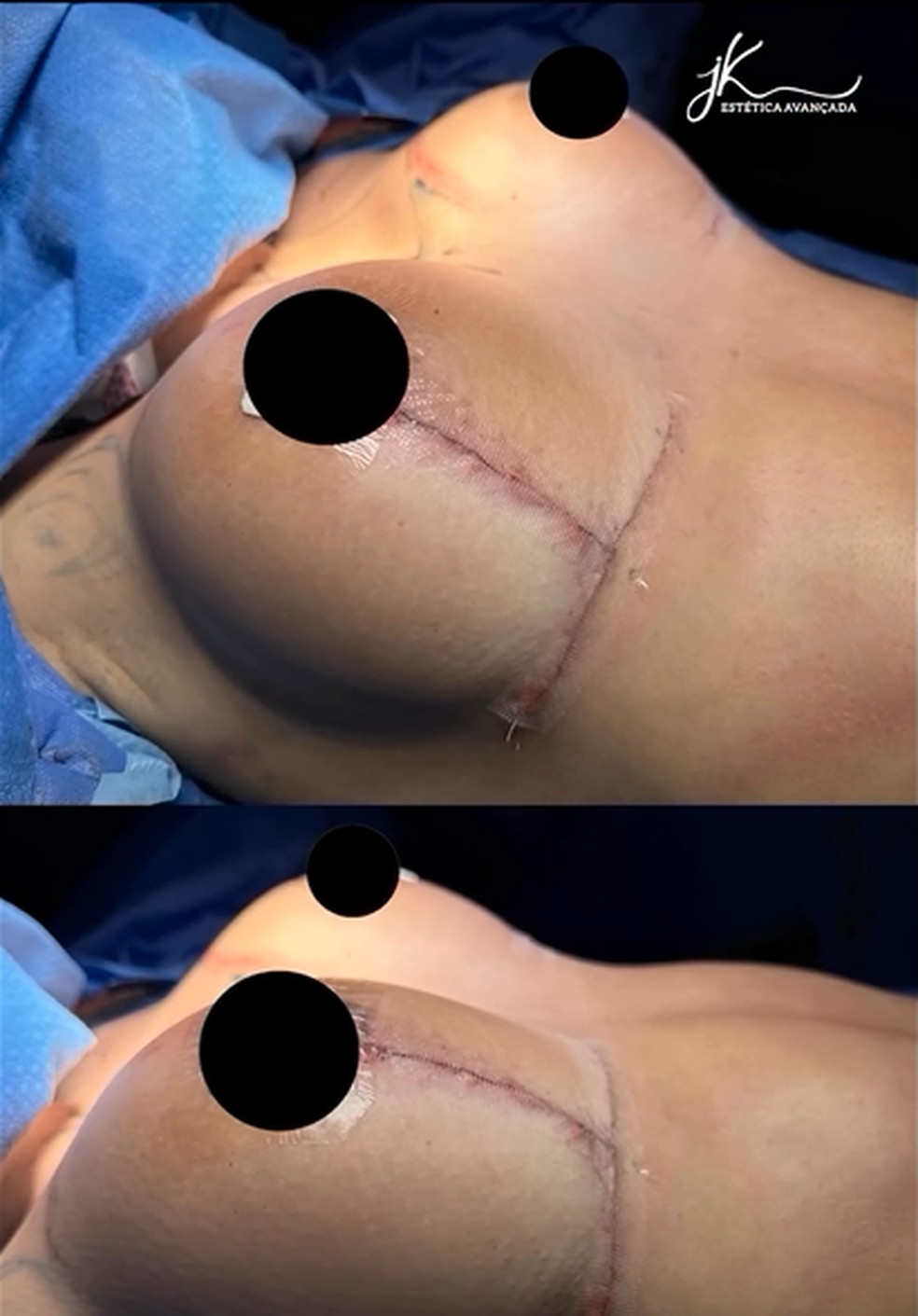 Karoline Lima mostra antes e depois de procedimentos estéticos — Foto: Reprodução/Instagram