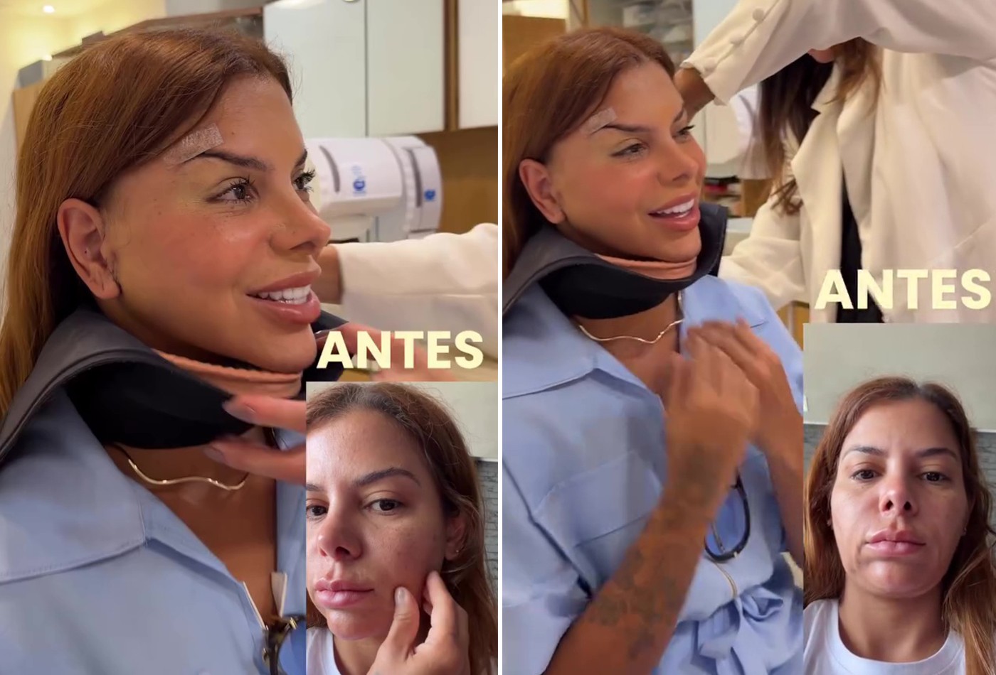 Evelyn Regly mostra resultado de cirurgias no rosto: 'Já estou adorando'
