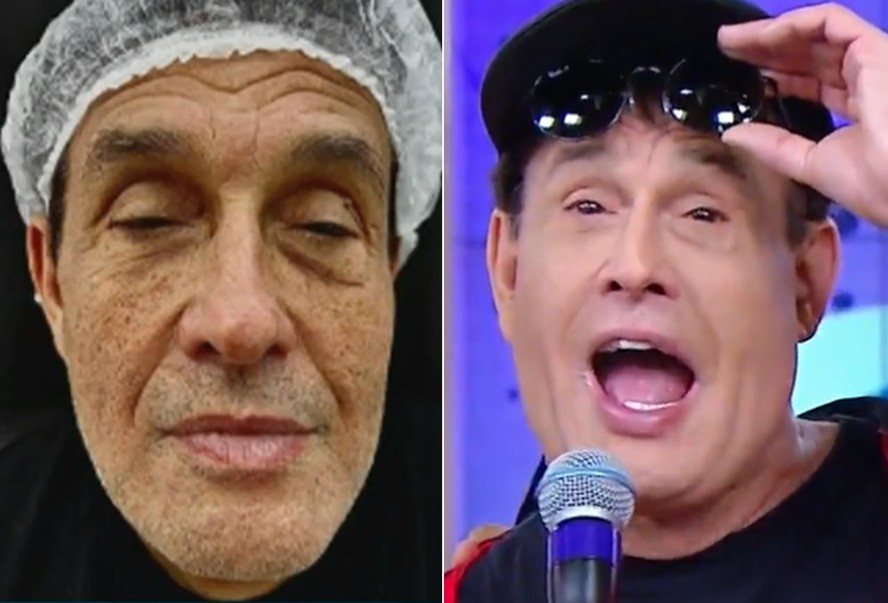 O antes e depois das harmonizações faciais de Sérgio Mallandro