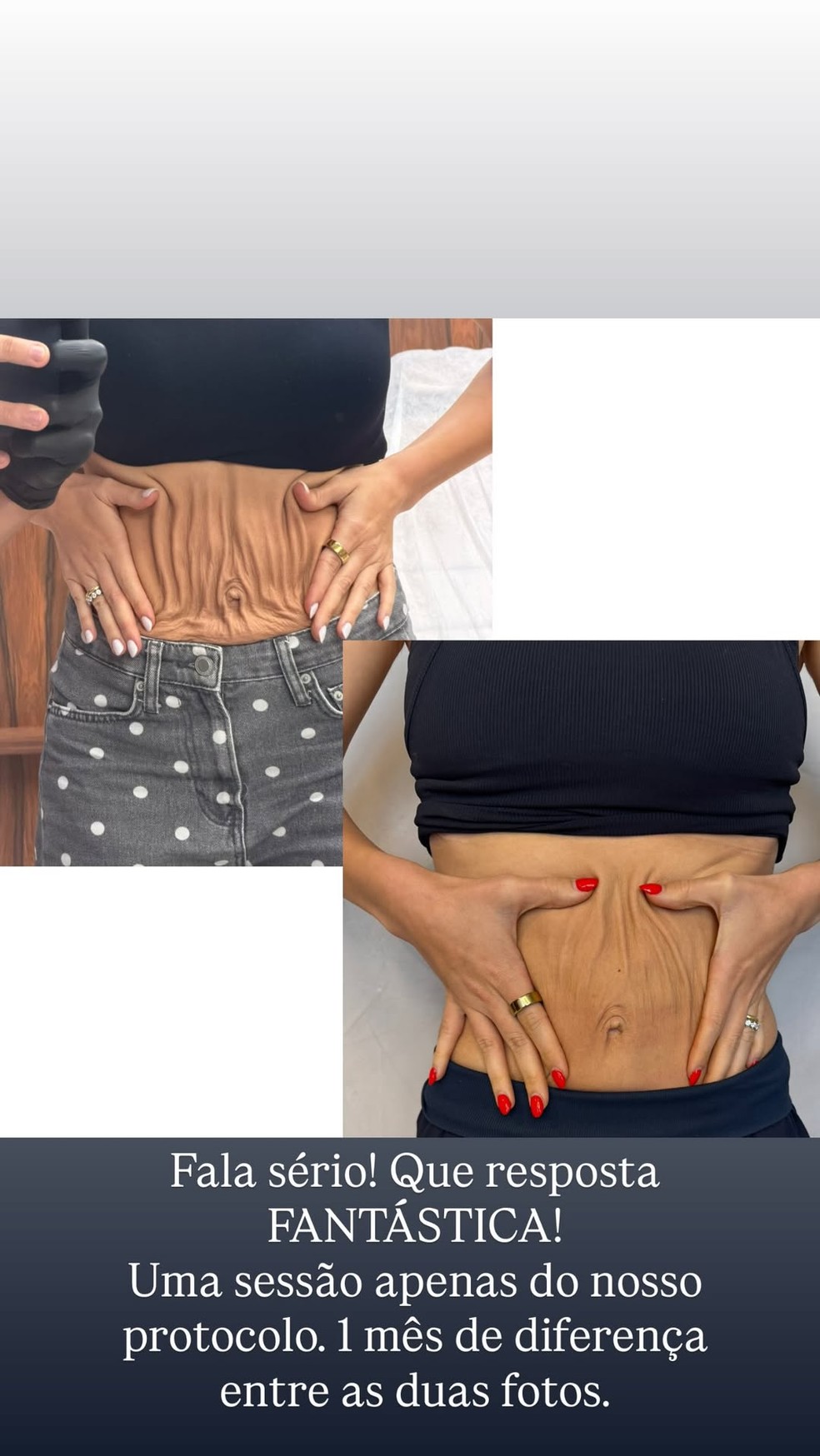 Um mês após reclamar de barriga 'flácida' e 'umbigo caído', Lyandra Costa se surpreende com resultado de procedimento — Foto: Reprodução/Instagram