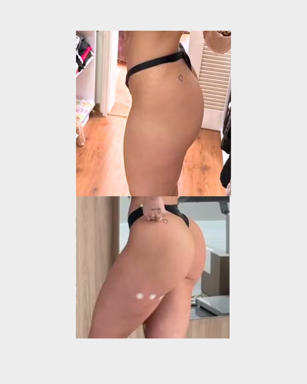 Antes e depois de Raíssa Souza — Foto: @raissasouzatv_ | @dradanuzaalves | @clinicaleger | CO ASSESSORIA