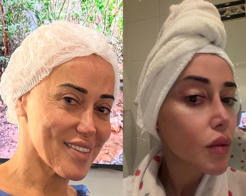 Marcela Porto, a Mulher Abacaxi, antes e depois da feminização facial — Foto: Arquivo pessoal